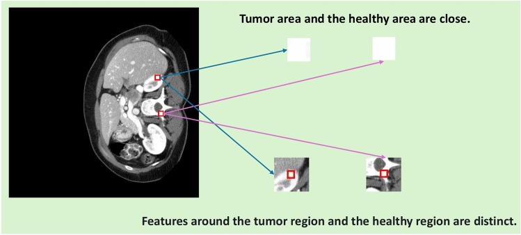 GNNs surpass transformers in tumor medical image segmentation.