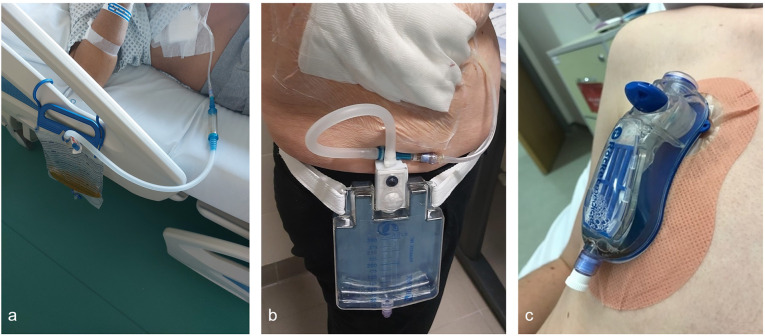 A Practical Approach to Pneumothorax Management.