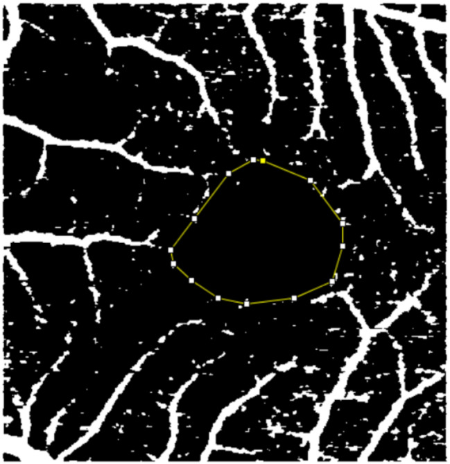 Effect of disease duration on foveal microvasculature assessed by OCTA in type 2 diabetes mellitus without clinical diabetic retinopathy.
