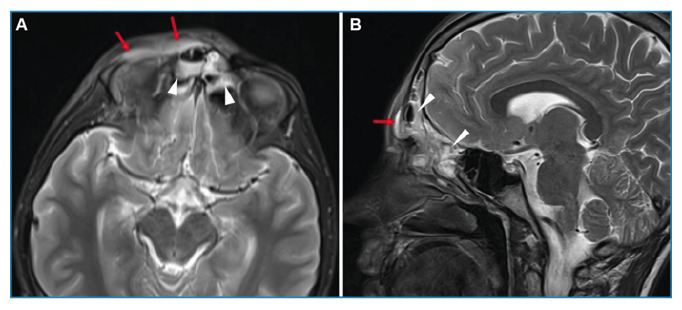 Widespread Encephalitis Following Acute Sinusitis in a Pediatric Patient.