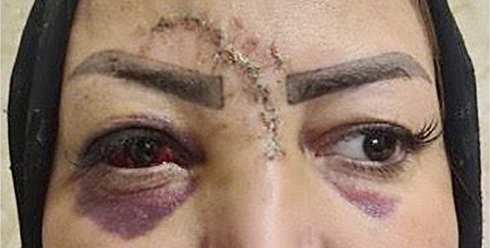 Double Jeopardy: Uncommon Concurrent Traumatic Optic Neuropathy and Central Retinal Artery Occlusion - A Case Report.