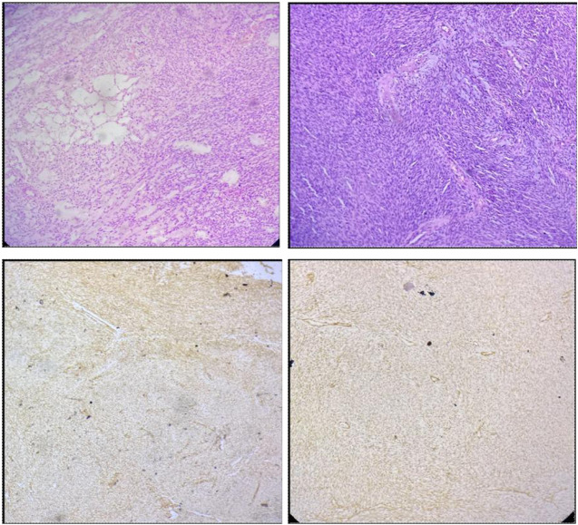Unusual Retroperitoneal Soft Tissue Sarcomas: Giant Masqueraders.