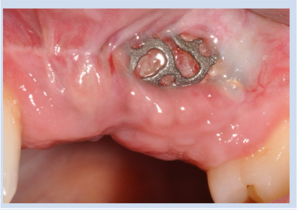 Risk factors for dehiscence in alveolar ridge augmentation using patient-specific titanium mesh: a retrospective analysis.