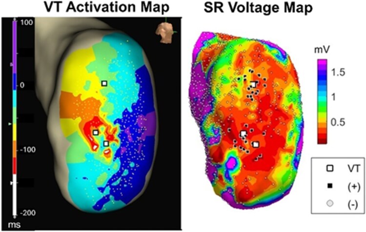 Machine learning approach for automated localization of ventricular tachycardia ablation targets from substrate maps: development and validation in a porcine model.