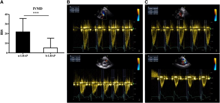 Enhanced ventricular synchrony and myocardial function with bipolar left bundle area pacing: a comparative study of anodal ring capture versus unipolar pacing.