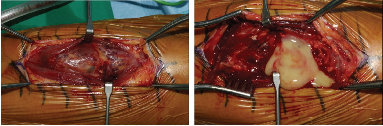 A rare case of pyomyositis with intramuscular hemangioma in the upper arm.