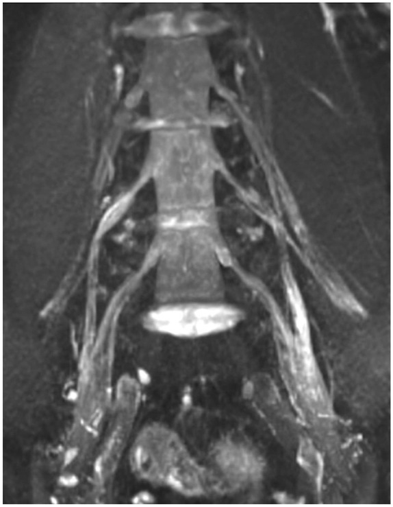 Comparison of imaging markers of nerve ultrasound and MR-neurography in a longitudinal course in chronic inflammatory demyelinating polyneuropathy.