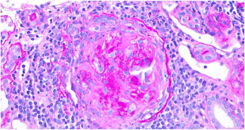 Acute Kidney Failure in Limited Scleroderma Reveals Anti-GBM--Associated Kidney Disease