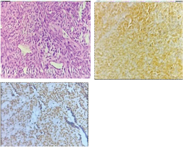 Unusual Retroperitoneal Soft Tissue Sarcomas: Giant Masqueraders.