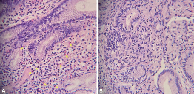 Chronic Eosinophilic Gastritis Presenting as Gastric Outlet Obstruction in a Young Man: A Case Report.