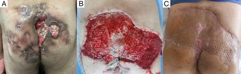 Massive Malignant Transformation in a Patient with Hidradenitis Suppurativa during Anti-Tumor Necrosis Factor Treatment.
