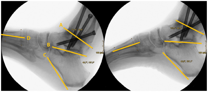 Compensatory Movements of the Midfoot Joints Influence Gait Pattern After Arthroscopic Ankle Arthrodesis.