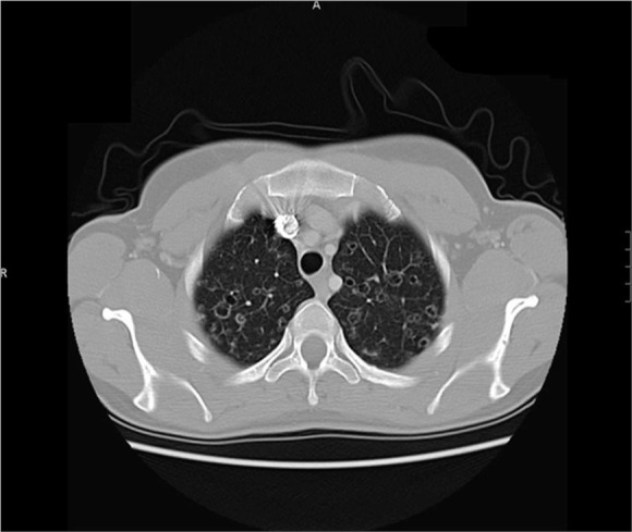 Pulmonary Langerhans cell histiocytosis: A case series and literature review.