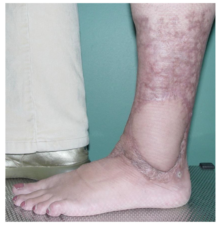 Anterolateral Thigh Flap for Acute/Primary Burn Reconstruction.