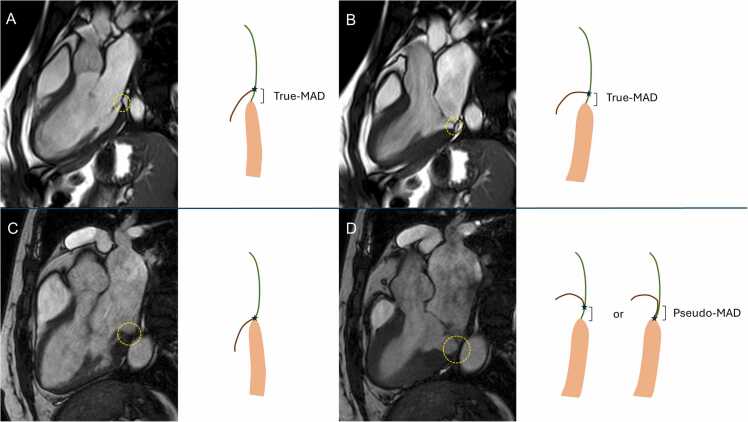 True- and pseudo-mitral annular disjunction in patients undergoing cardiovascular magnetic resonance.