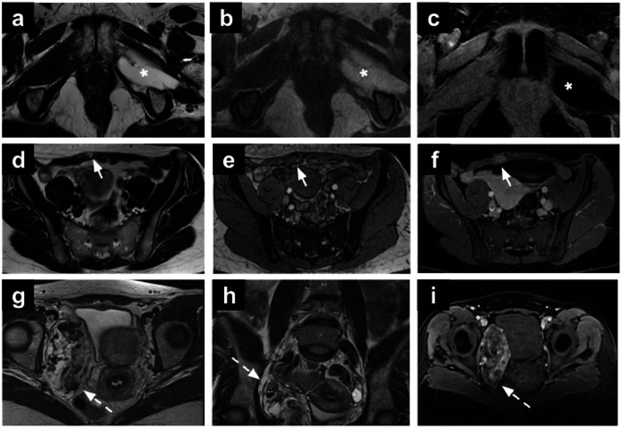 Incidental findings in female pelvis MRI performed for gynaecological malignancies.