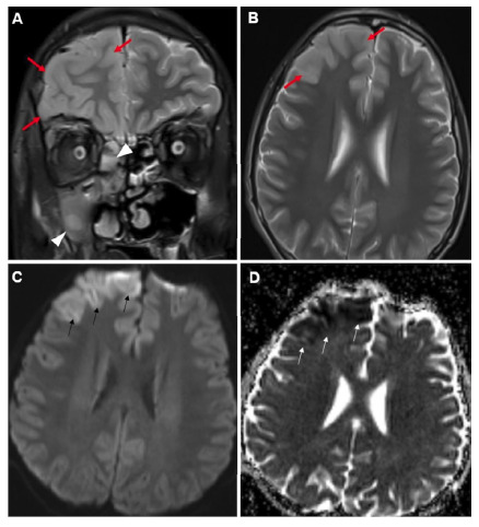 Widespread Encephalitis Following Acute Sinusitis in a Pediatric Patient.
