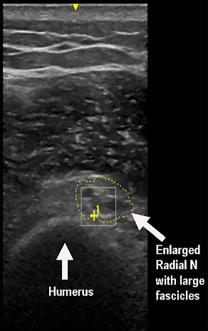Radial Nerve Palsy as an Iatrogenic Complication of Shoulder Replacement Surgery With Significant Bone Loss of the Humerus Resembling Gorham-Stout Disease: Case Report and Review of the Literature.