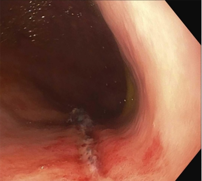Efficacy and safety of single use duodenoscopes in comparison to reusable duodenoscopes for endoscopic retrograde cholangiopancreatography: A single center experience.