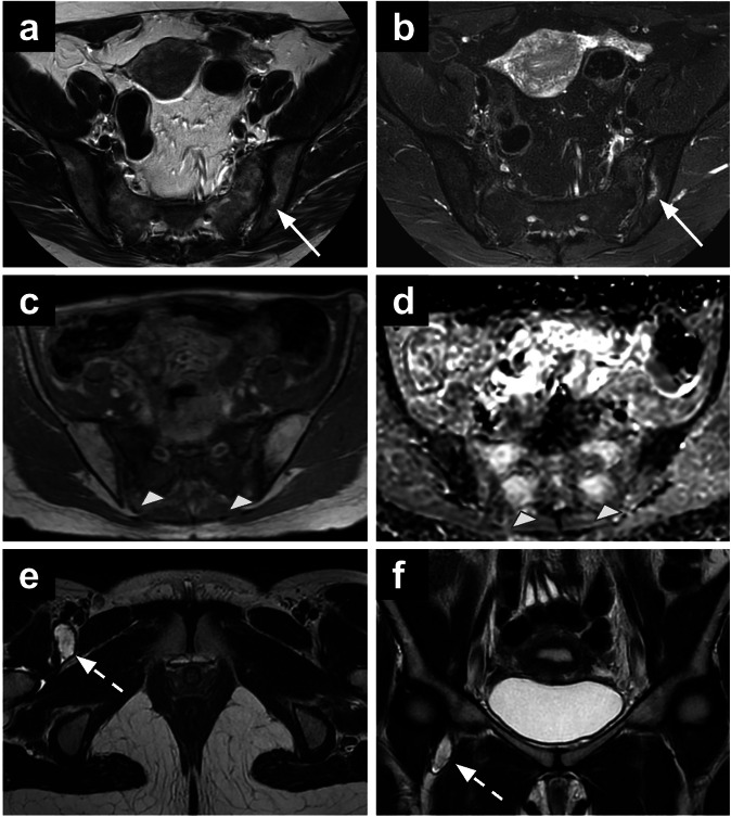 Incidental findings in female pelvis MRI performed for gynaecological malignancies.