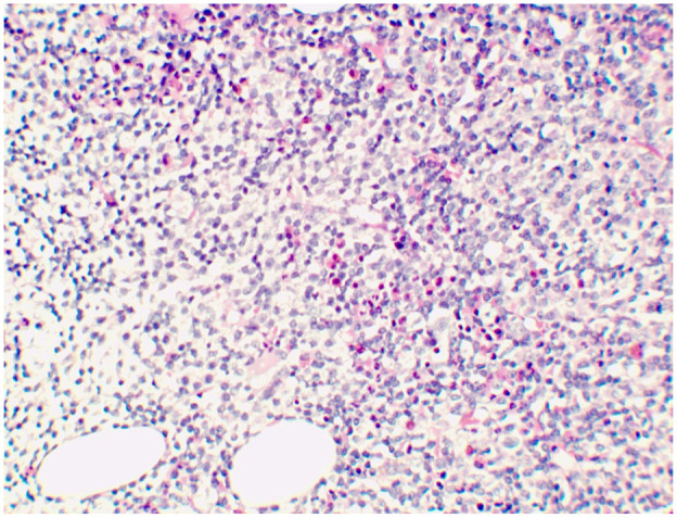 Extranodal Marginal Zone Lymphoma Presenting as Acute Kidney Injury due to Cast Nephropathy: A Case Report.