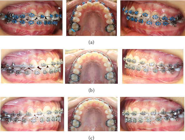 The Use of the Surgical Guide for Placing Miniscrew in Treatment of Class II Subdivision: A Case Report With 2-Year Follow-Up.