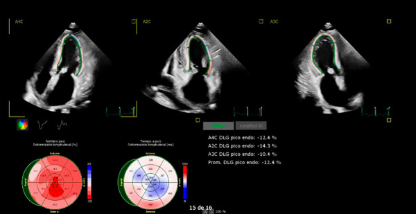 Monoclonal gammopathy progressing to systemic amyloidosis with cardiac involvement. A case report.