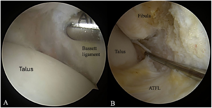 All-Inside Arthroscopic Brostrom Repair with Suture Tape Augmentation: A Technical Description.