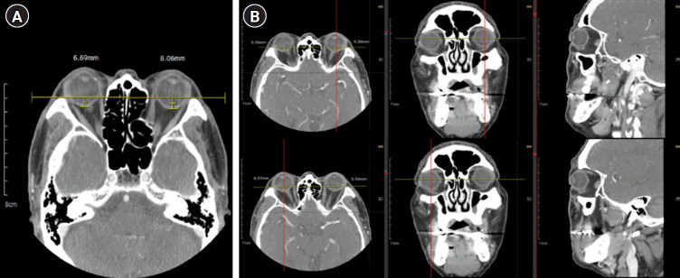 The efficacy of radiotherapy for steroid-resistant thyroid eye disease: clinical outcomes in orbital inflammation and exophthalmos.