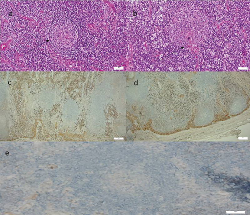 <sup>18</sup>F-FDG PET/CT of a Multicentric Castleman Disease with Lymph Node and Skin Involvement.