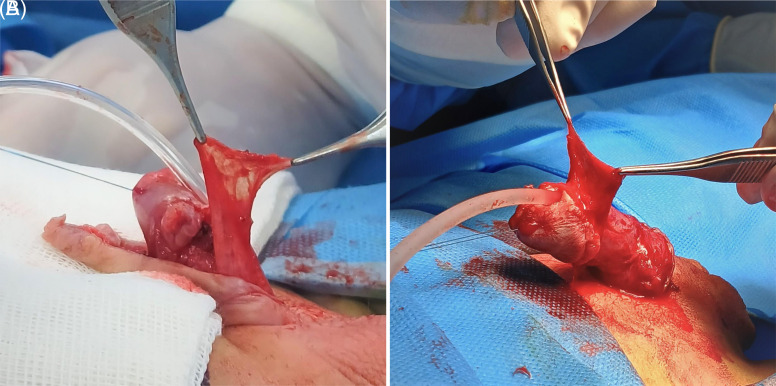 Comparison of the Surgical Results of Ventral and Dorsal Dartos Flaps in Tubularized Incised Plate Urethroplasty for Distal Hypospadias: A Randomized Clinical Trial.