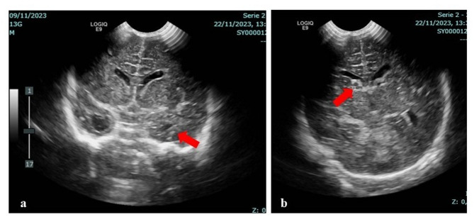 Congenital cytomegalovirus infection and brain injury in a newborn following maternal non-primary infection: case report of an unexpected diagnosis.
