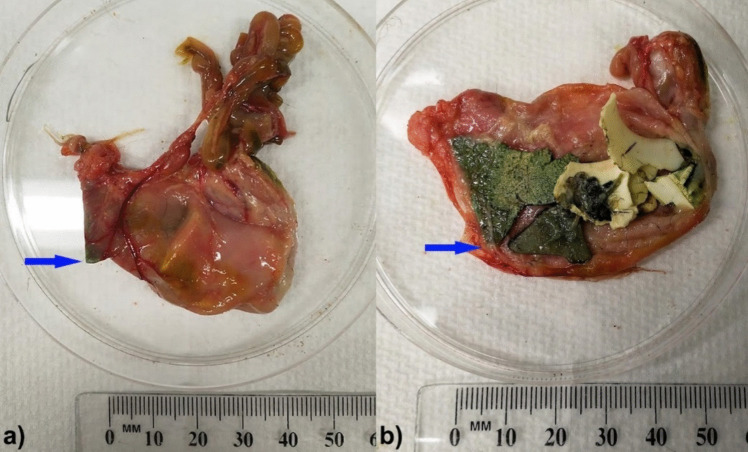 Alterations in characteristics of plastic ingestion and decreasing body condition in beachcast fledgling short-tailed shearwaters (Ardenna tenuirostris) at Phillip Island, Australia
