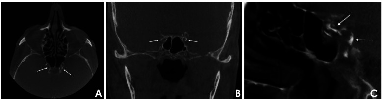 Vascular-related cone-beam computed tomographic findings in healthy and medically compromised patients: A study based on self-reported medical history data.