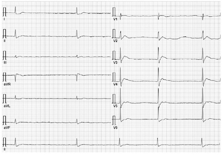 Atrial fibrillation with slow-ventricular response (AF-SVR): A literature review.