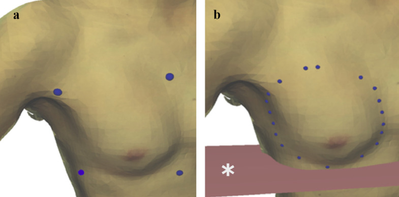 Use of Three-Dimensional Surface Imaging to Measure Breast Volume in the Upright Position With Acceptable Accuracy.