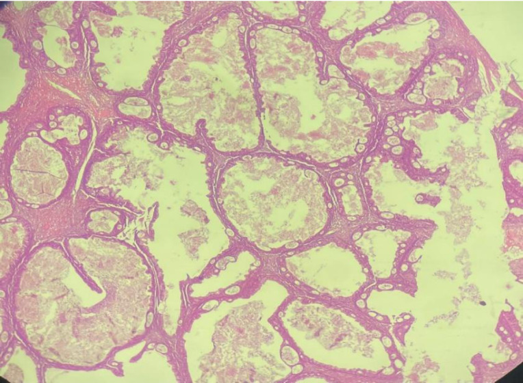 Giant Cystic Mucinous Borderline Tumour of the Ovary in a Young Female: A Rare Case Report.