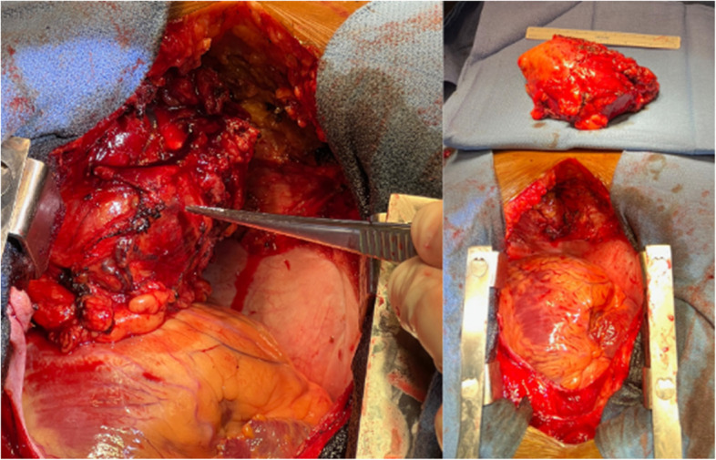 Rare case of a massive anterior mediastinal schwannoma causing cardiac compression with concurrent cervical spine lesion causing spinal cord compression.