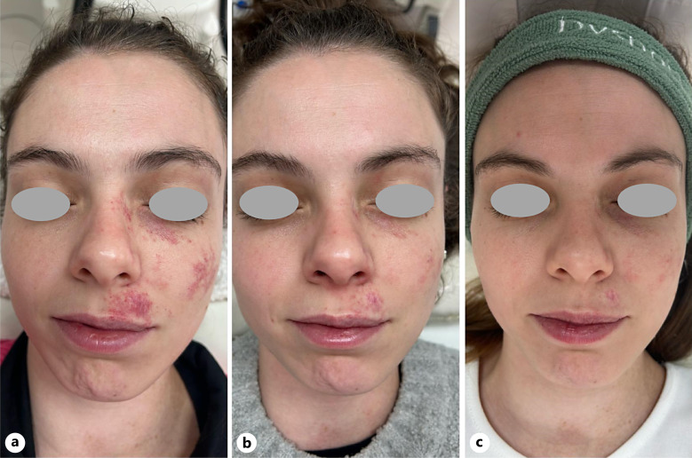 Efficacy of Sequential Combination of Long-Pulsed Potassium Titanyl Phosphate 532-nm and Quasi Long-Pulsed 1,064-nm Nd:YAG Laser Therapy for Port-Wine Stain Treatment: A Case Report.