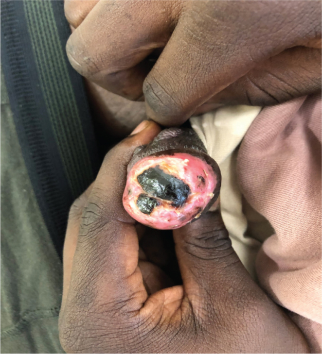 Penile Ulceration After Local Injection of Metaphedrone During Chemsex.