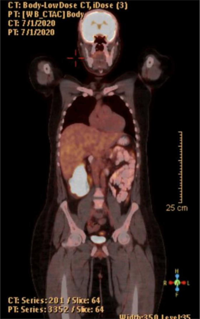 Long-Term Survival for Locally Advanced Adenosquamous Carcinoma Colon Cancer in Ulcerative Colitis: A Case Report.