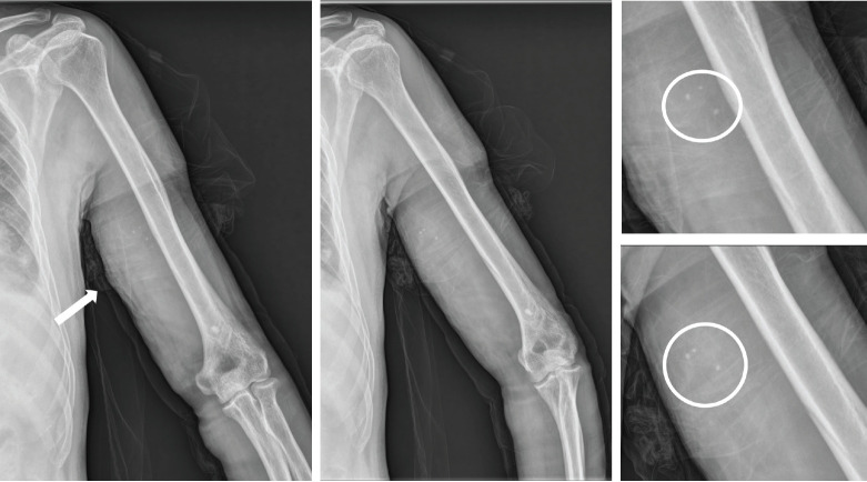 A rare case of pyomyositis with intramuscular hemangioma in the upper arm.