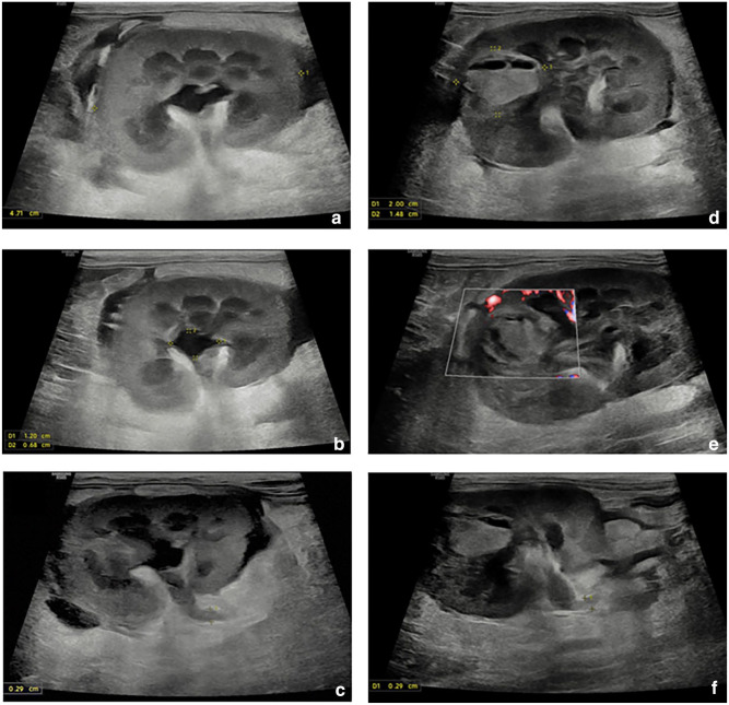 Renal parenchymal rupture, pelvic rupture and uroabdomen secondary to bilateral renal hemorrhage and pyelonephritis in a cat.