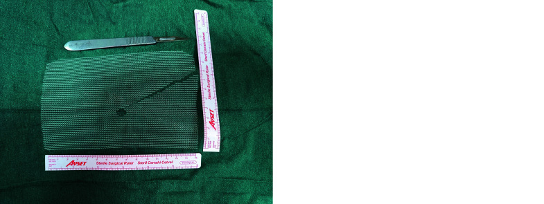 Slit mesh technique in laparoscopic inguinal hernia repair: a retrospective analysis.