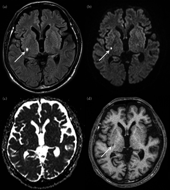 Hemichorea Associated With Nigrostriatal Dysfunction: Case Report of a Patient With an Ipsilateral Infarct in the Lenticular Nucleus and Internal Capsule.