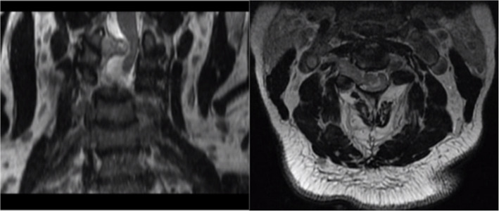 Rare case of a massive anterior mediastinal schwannoma causing cardiac compression with concurrent cervical spine lesion causing spinal cord compression.