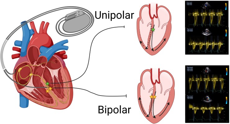 Enhanced ventricular synchrony and myocardial function with bipolar left bundle area pacing: a comparative study of anodal ring capture versus unipolar pacing.