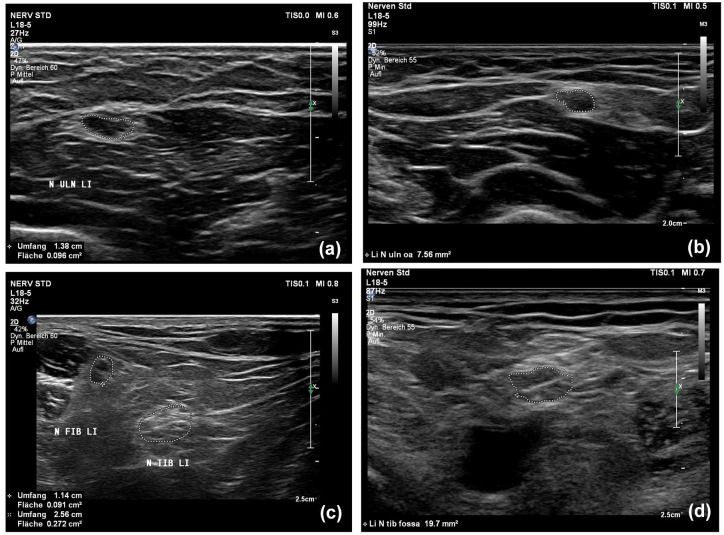 Comparison of imaging markers of nerve ultrasound and MR-neurography in a longitudinal course in chronic inflammatory demyelinating polyneuropathy.