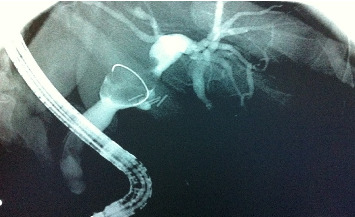 Clear Cell Carcinoma: A Rare Variant of Cholangiocarcinoma Case Report and Systematic Review.