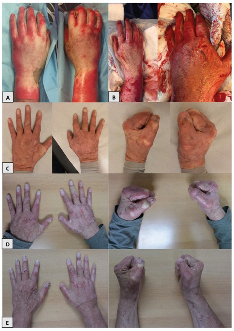 Hand Function Recovers to Near Normal in Patients with Deep Dermal Hand Burns Treated with Enzymatic Debridement: A Prospective Cohort Study.